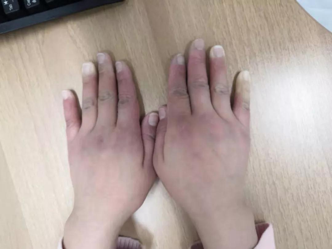 “手指、腳趾發(fā)白、發(fā)紫……”這些“小毛病”千萬別大意