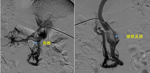 血栓攔路，如何破局——罕見巨大門靜脈血栓TIPS手術(shù)實錄