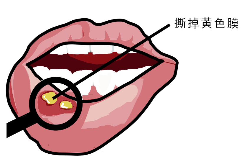 經(jīng)?？谇粷?，真的只是缺維生素嗎？