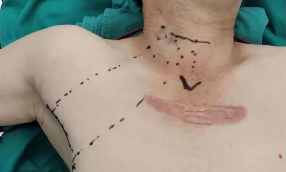 術(shù)后傷口可以“隱身”嗎？