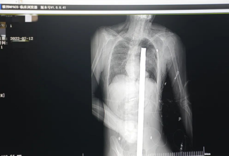 1.2米長(zhǎng)的鋼筋貫穿男子胸腹！情況極度危險(xiǎn)......