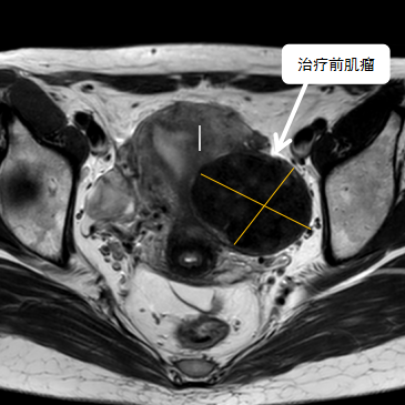 保子宮、保留生育功能—磁波刀治療子宮肌瘤