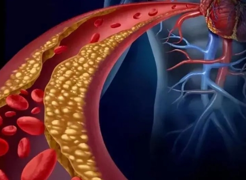 警惕！冠脈支架術(shù)后這些誤區(qū)千萬別踩，趕緊收藏！