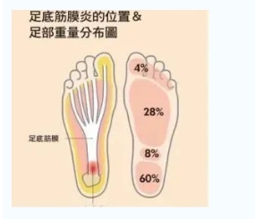 每年新生數(shù)百萬足底筋膜炎患者！國際醫(yī)學(xué)專家提醒：跑步要選擇合適的鞋