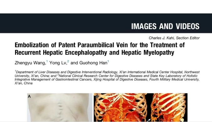 我院護(hù)理團(tuán)隊臨床成果登榜國際肝病權(quán)威期刊，影響因子11.6